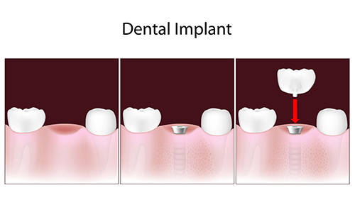 dental implants Greenville
